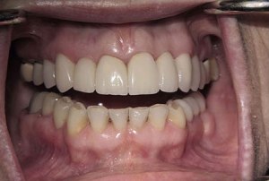 Teeth after dental crowns photo