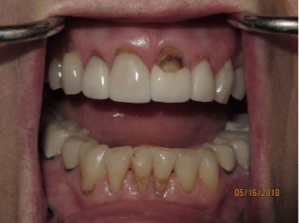 Teeth before dental crowns photo