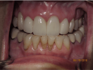 Teeth after dental crowns photo