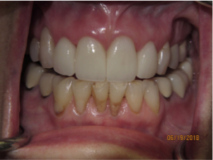 Teeth after dental crowns photo