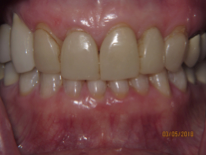 Teeth before porcelain veneers photo