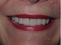 Smile after porcelain veneers photo