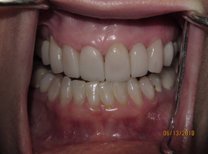 Teeth after porcelain veneers photo