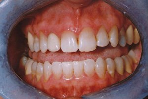 Teeth before porcelain veneers photo