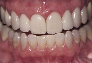 Teeth after porcelain veneers photo