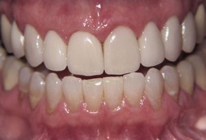 Teeth after porcelain veneers photo