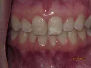 Teeth before porcelain veneers photo