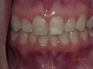 Teeth before porcelain veneers photo