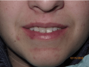 Smile before porcelain veneers photo