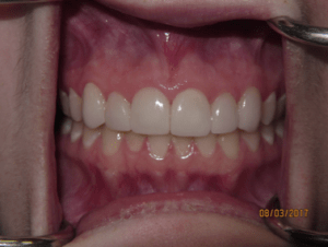 Teeth after porcelain veneers photo