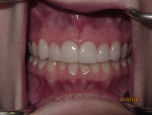 Teeth after porcelain veneers photo
