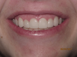 Smile after porcelain veneers photo