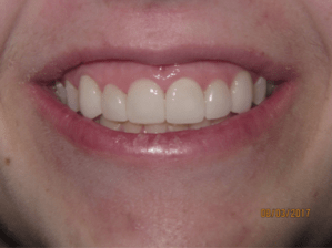 Smile after porcelain veneers photo