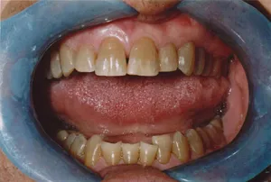 Teeth before teeth whitening photo