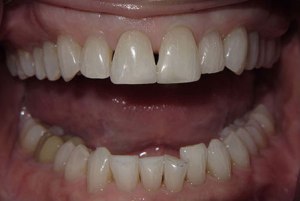 Teeth after teeth whitening photo