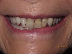 Smile before gum surgery and dental crowns photo