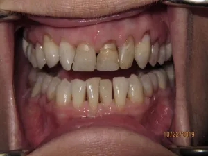 Teeth before gum surgery and dental crowns photo