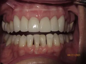 Teeth after gum surgery and dental crowns photo