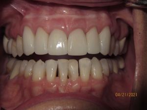 Teeth after gum surgery and dental crowns photo