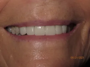 Smile after gum surgery and dental crowns photo