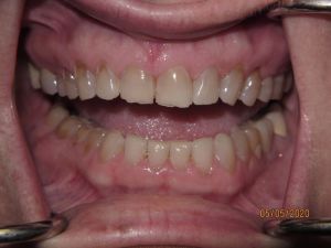 Teeth before porcelain veneers photo