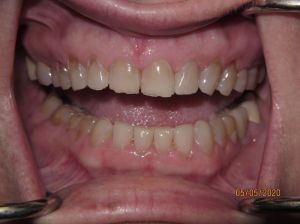 Teeth before porcelain veneers photo