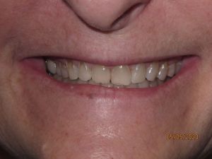 Smile before porcelain veneers photo