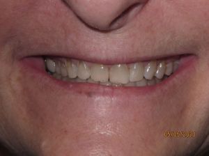 Smile before porcelain veneers photo