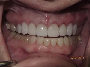 Teeth after porcelain veneers photo