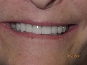 Smile after porcelain veneers photo