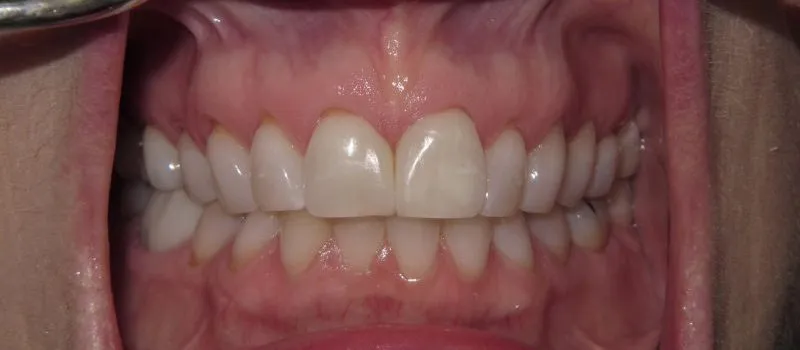 Teeth after bioclear method